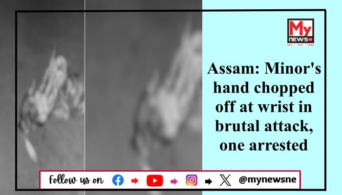 Assam: Minor's hand chopped off at wrist in brutal attack, one arrested